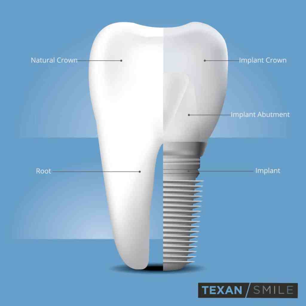 Dental implant structure showing implant post and replacement tooth